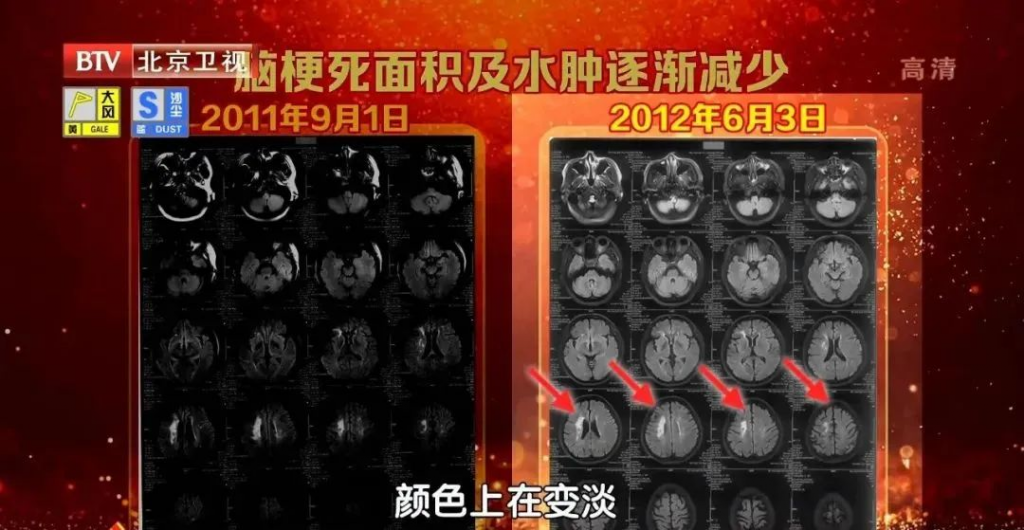 每天多做一项训练，打开脑卒中的“自救开关”！早练早受益，没病也能做~