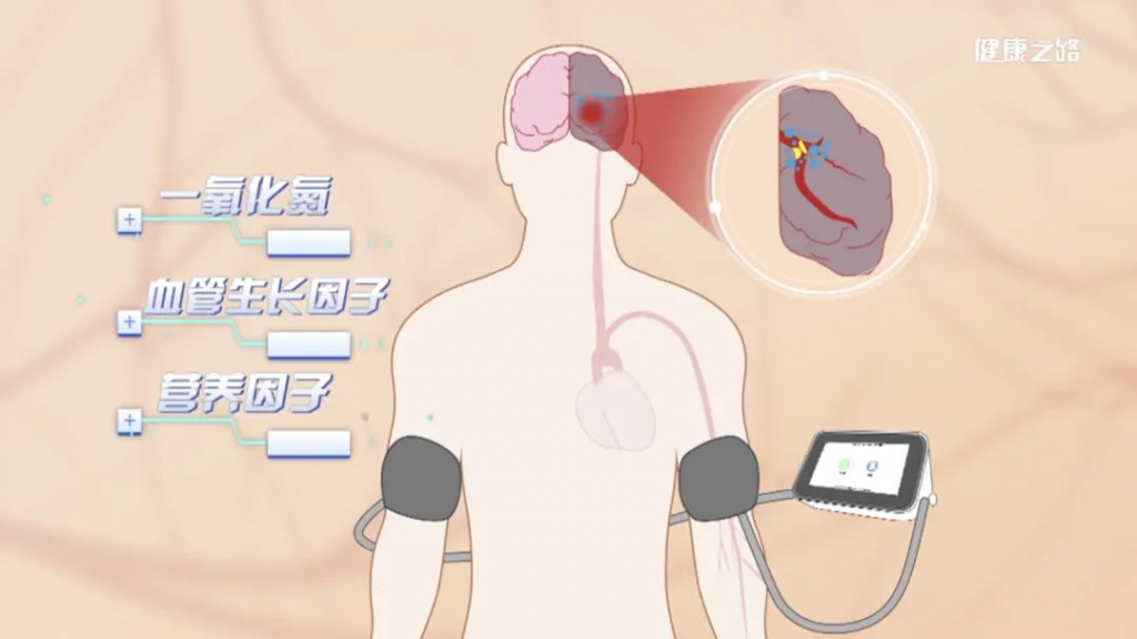 厉害了！两大新型脑卒中抢救和康复手段，为脑卒中患者的健康保驾护航！｜健康之路