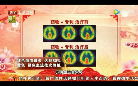 养生堂｜金标准影像看脑血流重建
